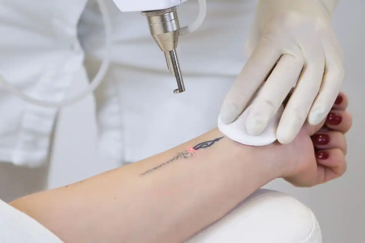Neatcell Tattoo Removal Reviews: A Month-Long Trial Revealed